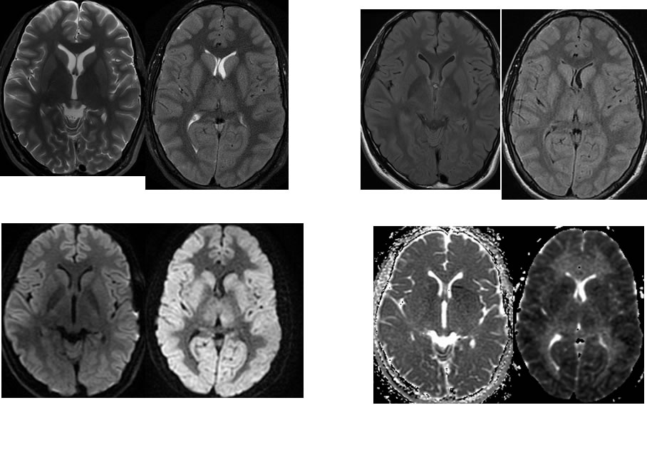 Diffuse Anoxic Brain Injury