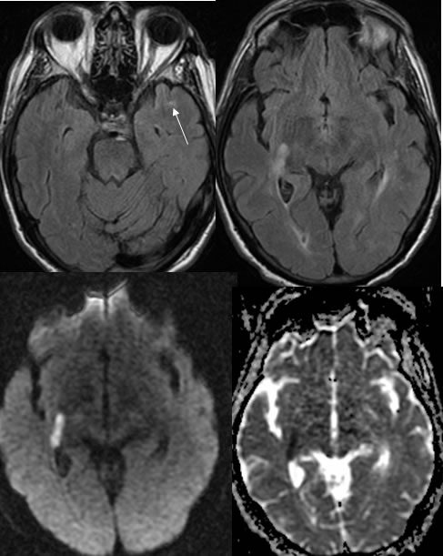 Multicentric GBM