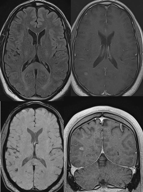 cavernoma