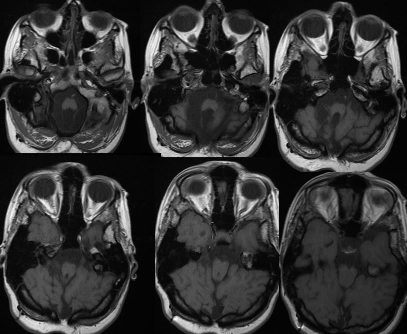 Chiari 3 malformation