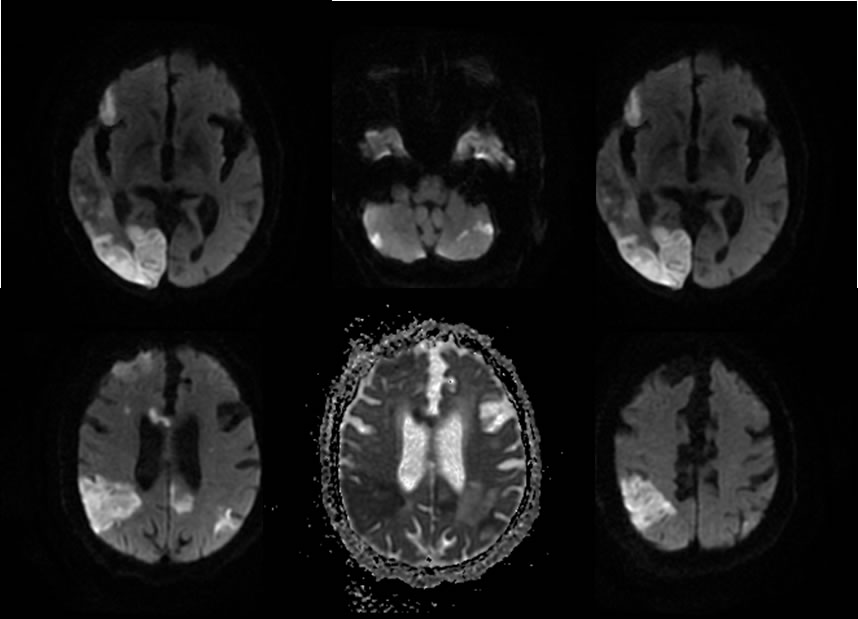 CNS vasculitis