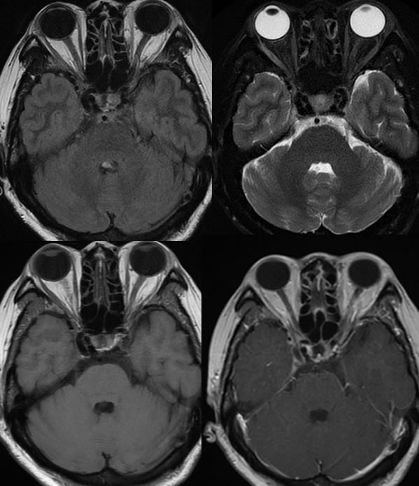 Direct Carotid Cavernous Fistula