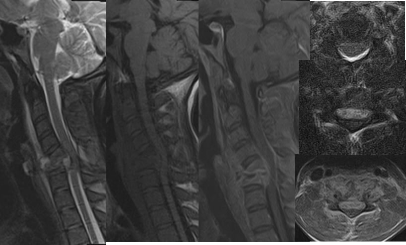 discitis osteomyelitis cervical