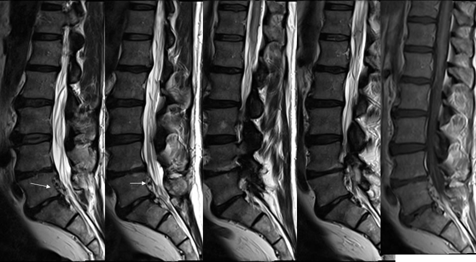 Epidural AVM