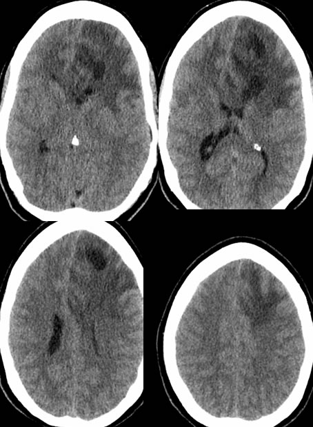 Grade 3 Astrocytoma