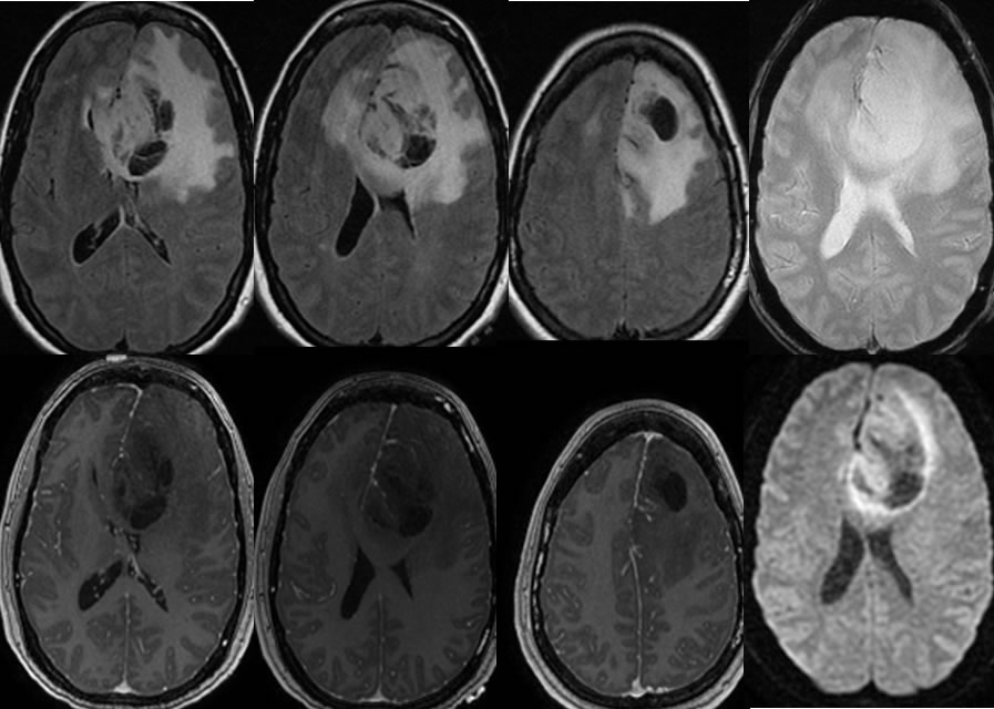 Grade 3 Astrocytoma