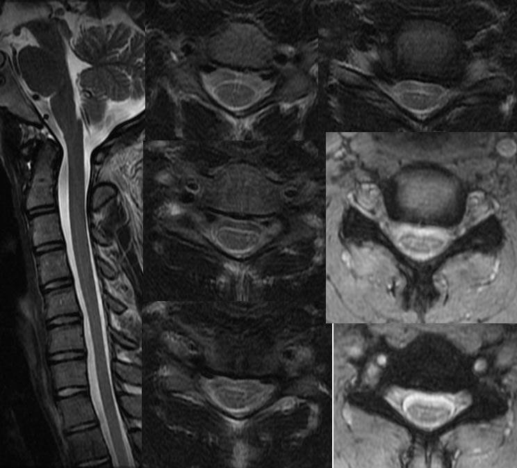 Hirayama's Disease