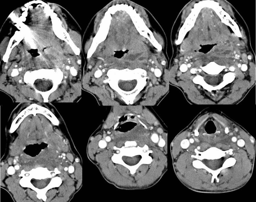 prevertebral abscess