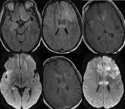 Gliomatosis Cerebri