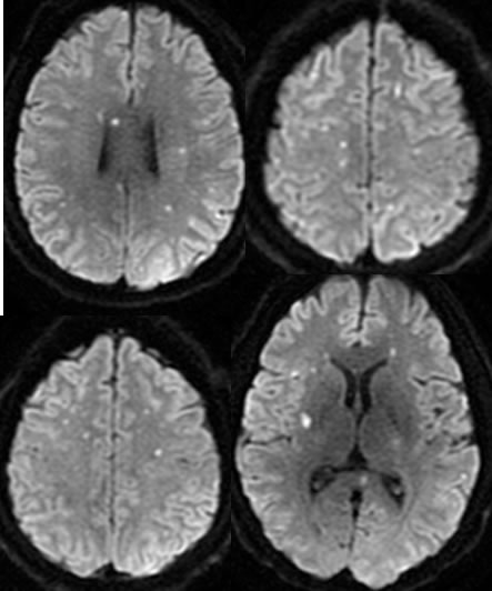 Susac Syndrome, acute