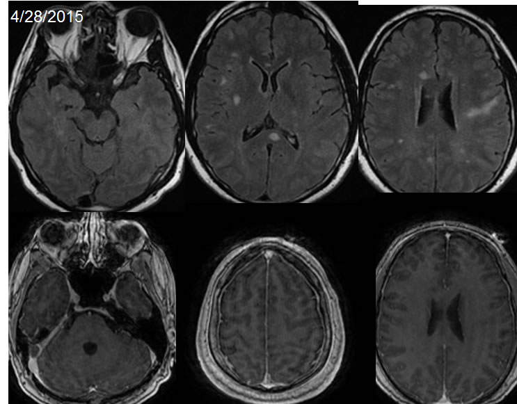 Susac Syndrome, acute